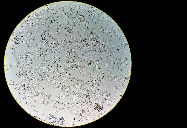 Abnormal result of urinalysis examination by microscope showing many epithelial cells and RBC