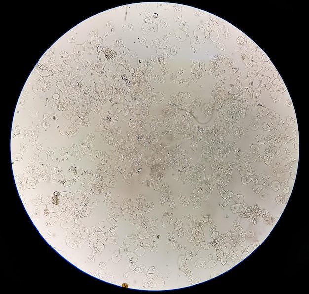 Abnormal result of urinalysis examination under microscopy