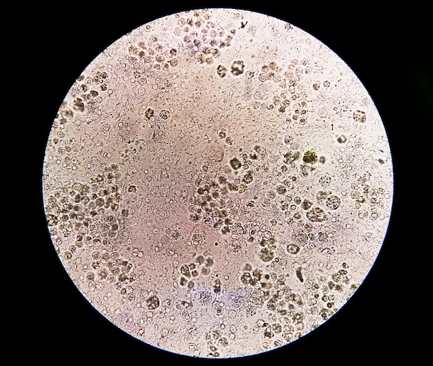 Abnormal urinalysis called Pyuria or leukocyturia with 40x light photomicrographic view