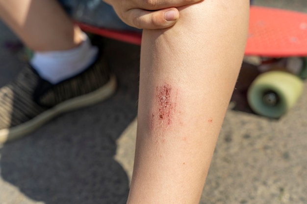 An abrasion on a child's leg from falling on an asphalt path while riding a skateboard the boy fell while riding a skateboard Extreme sports