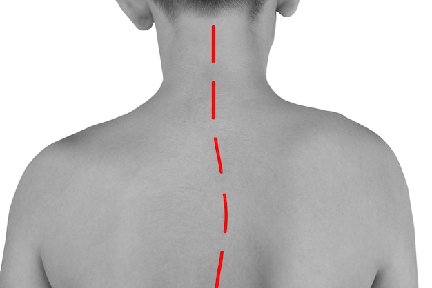 Achterkant van een tiener met spinale scoliose Gebogen rug op wit Zwart-wit foto met een rode lijn