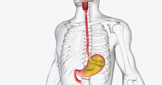 Acid reflux is caused by the involuntary release of stomach acid into the esophagus throat and mouth