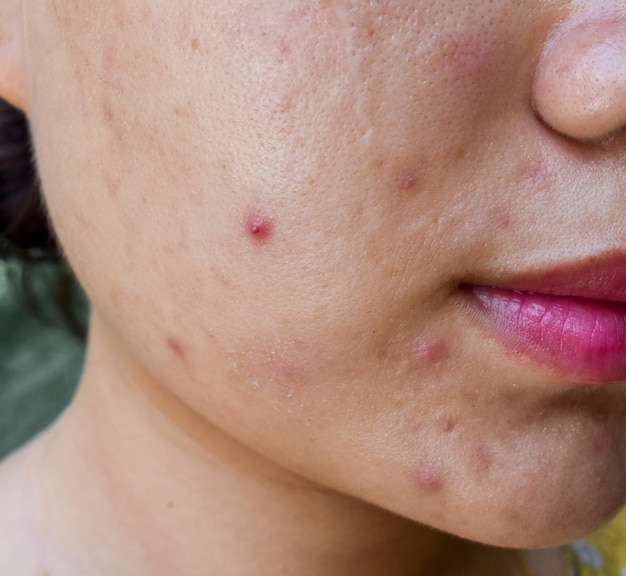 Acne black spots and scars oily on face