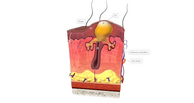 Acne is caused by a combination of factors acting on sebaceous glands and hair follicles in the skin