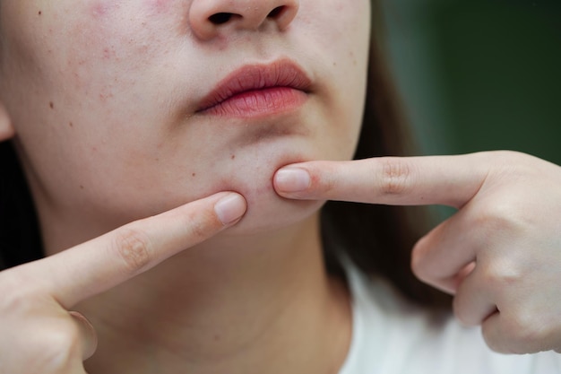 Acne pimple and scar on skin face disorders of sebaceous glands teenage girl skincare beauty problem