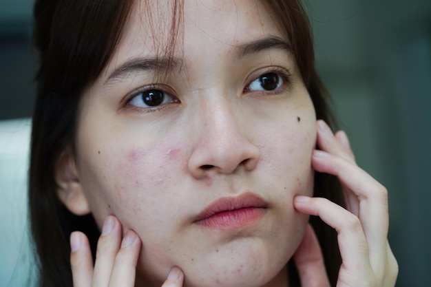 Acne pimple and scar on skin face disorders of sebaceous glands teenage girl skincare beauty problem