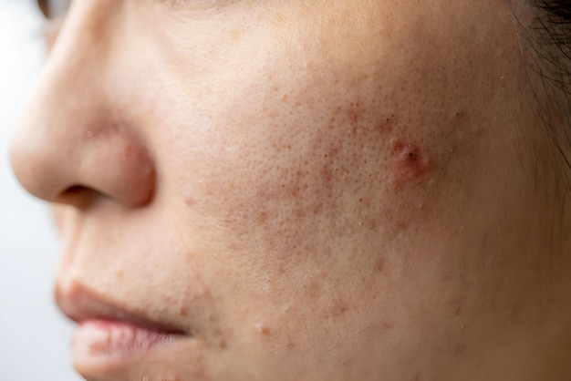 Foto problema di acne sul viso