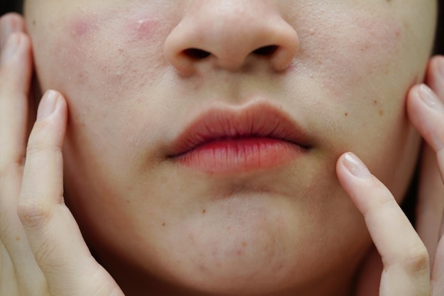 Acne puistje en litteken op de huid gezicht aandoeningen van de talgklieren tienermeisje huidverzorging schoonheidsprobleem