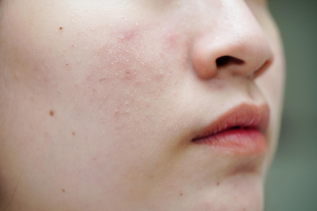 Acne puistje en litteken op de huid gezicht aandoeningen van de talgklieren tienermeisje huidverzorging schoonheidsprobleem