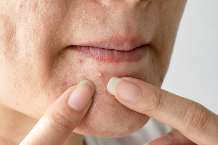 Acne pus, Close up photo of acne prone skin