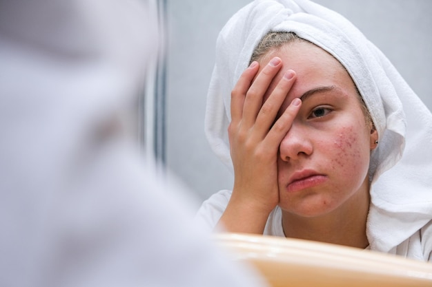 Foto acne. un'adolescente triste. pelle problematica negli adolescenti.