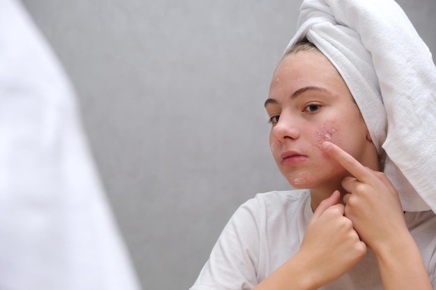 Acne. una ragazza adolescente che applica farmaci per l'acne sul viso davanti a uno specchio. cura per la pelle problematica