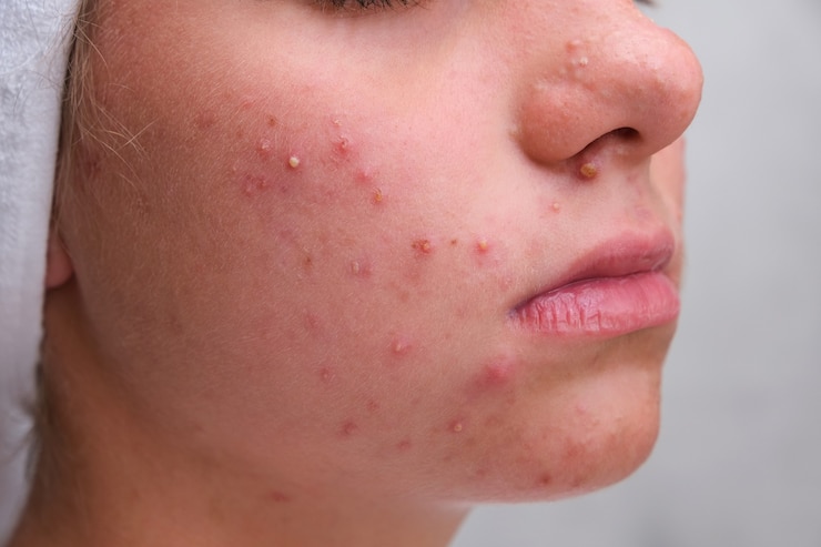 Foto acne. tienermeisje met de puistjes op haar gezicht. problematische huid. detailopname.