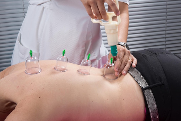 Acupuncture Fire cupping detail on woman's back