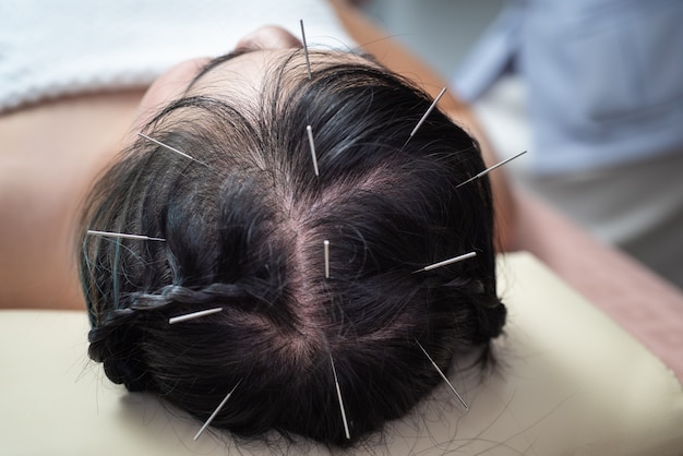 Acupuncture to the head .hair Glabrous