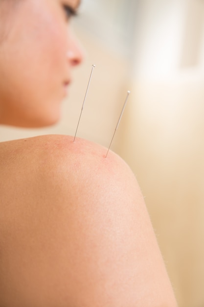 Acupuncture needle pricking on woman shoulder