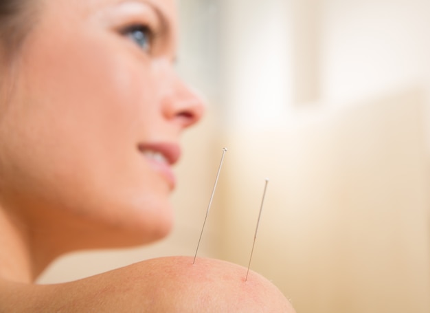 Acupuncture needle pricking on woman shoulder