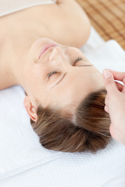 Acupuncture needles on a cauasian woman's head 