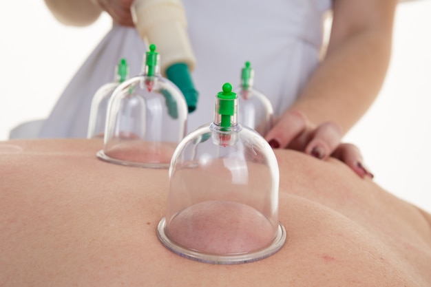 Acupuncture Therapist Placing Cup On The Back Of A Female Patient