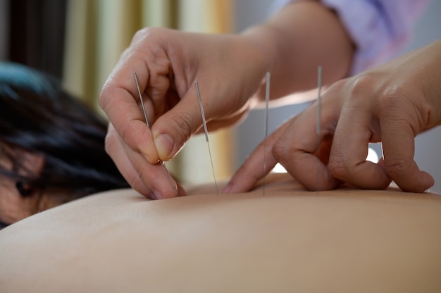 Photo acupuncture .women who are the back and acupuncture treatment at salon