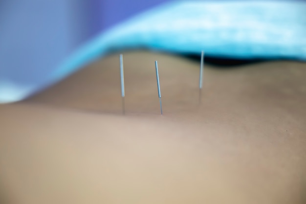 Foto acupunctuur