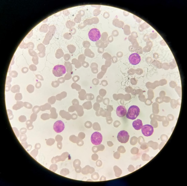 Acute myeloid leukemia (aml) cells analysed by light\
microscope. micrograph 200x zooming