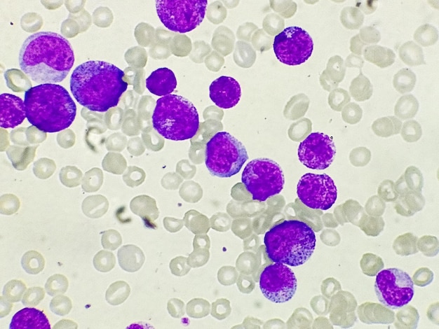 Acute myeloid leukemia (AML) is a type of blood cancer. Microscopic examination of blasts cells.