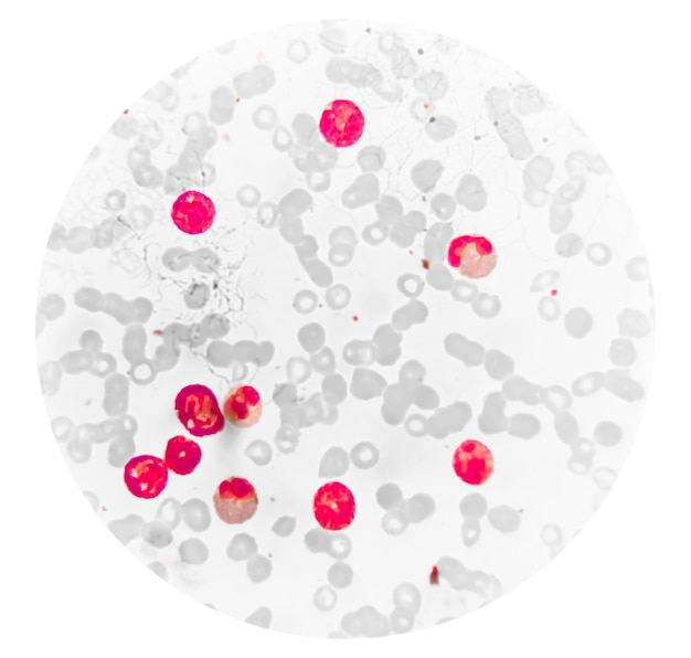 Acute myeloïde leukemie (AML) is een vorm van bloedkanker. Microscopisch onderzoek van blastcellen.