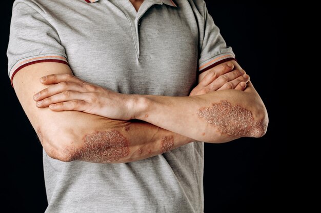 Acute psoriasis op de ellebogen is een auto-immuun ongeneeslijke dermatologische huidziekte Een grote rode ontstoken schilferige uitslag op de ellebogen Gewrichten aangetast door artritis psoriatica