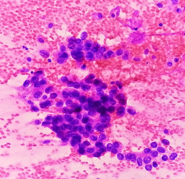 Adenocarcinoma of lung a type of non small cell carcinoma FNAC