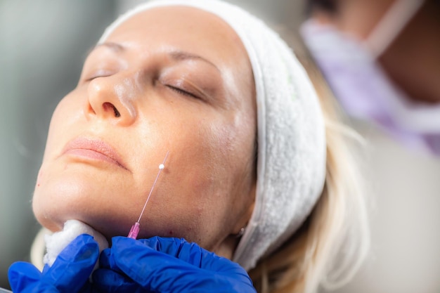 Aesthetic medicine facial contouring with 3d meso threads