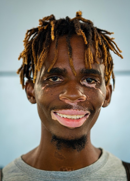 African American black young man with vitiligo skin pigment issue