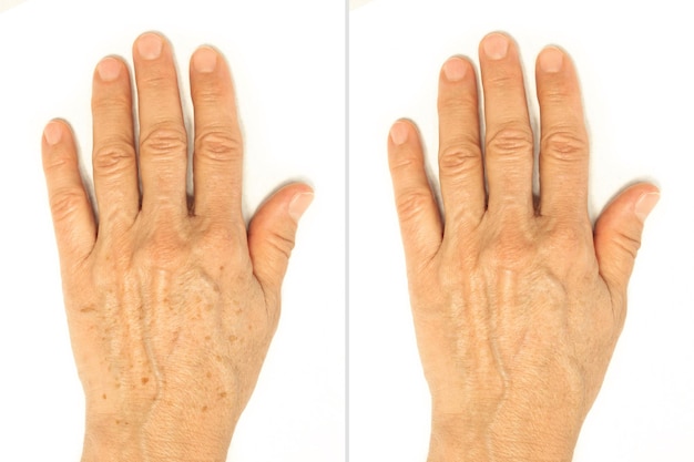 Photo age spots on the hands before and after removal using a lightening whitening cream rejuvenation