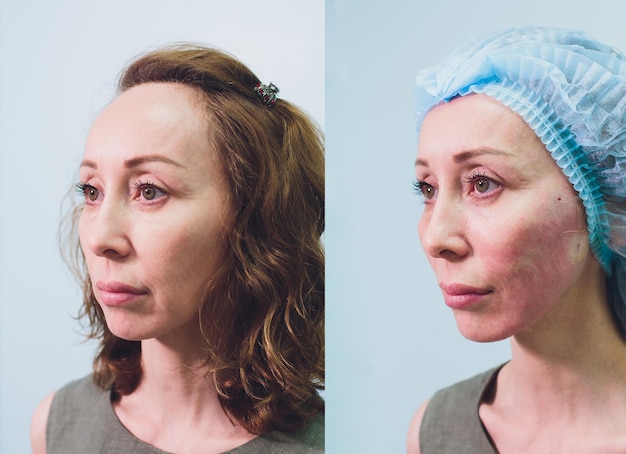 사진 메조스레드와 스레드 리프팅 미용을 하는 나이든 여성 노화의 징후를 제거하기 위한 미용 시술 4050세를 위한 미용 얼굴 안면 윤곽 성형 수술 개념
