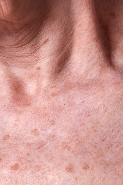 Aging female skin with melasma spots