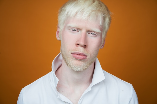 Albinism albino man