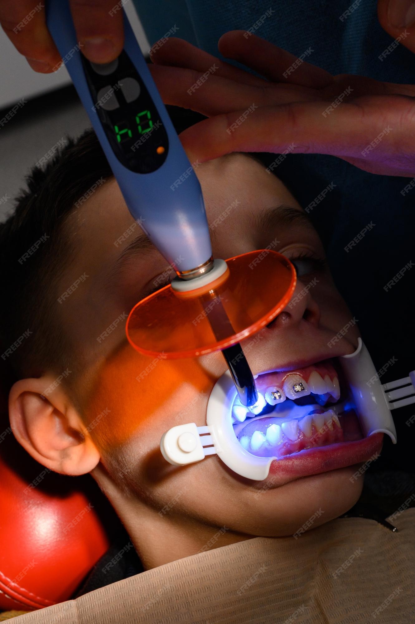 lv light for braces