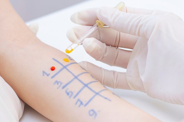 Allergeentest bij de hand. procedure van allergeenhuidtest in kliniek.