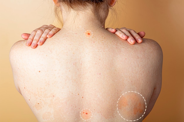 Allergic dermatitis on the skin of a woman's back. Skin disease. Neurodermatitis disease, eczema or allergy rash. Healthcare and Medical.