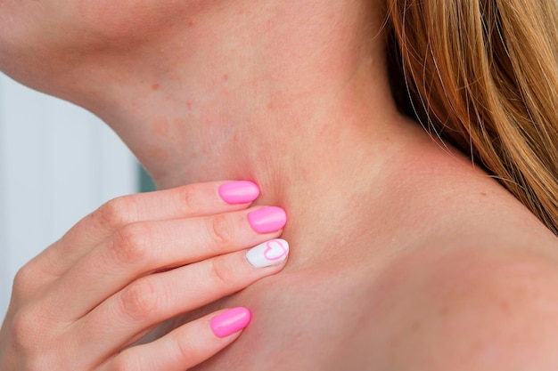 Allergic dermatitis on skin of woman's neck Skin disease Neurodermatitis disease eczema or allergy rash Healthcare and Medical Desquamation of skin