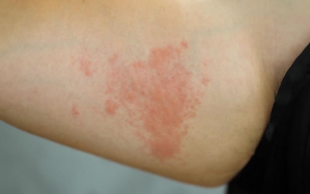 Allergic rush on skin