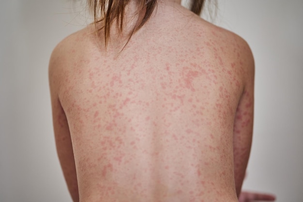 Allergische uitslag op het lichaam van de patiënt 5-jarig meisje