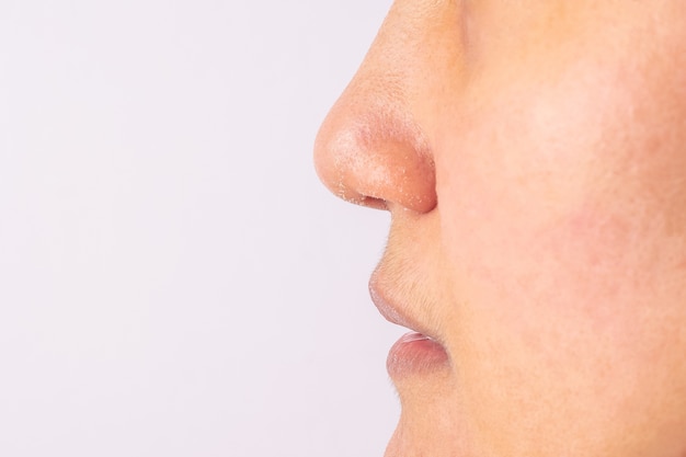 Allergische vrouwen hebben eczeem droge neus en lippen op wintertijd close-up.