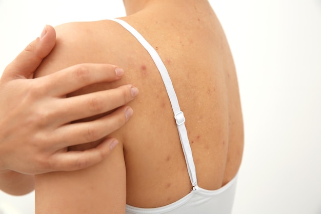 Allergy concept Woman scratching her shoulder with pimples on white background