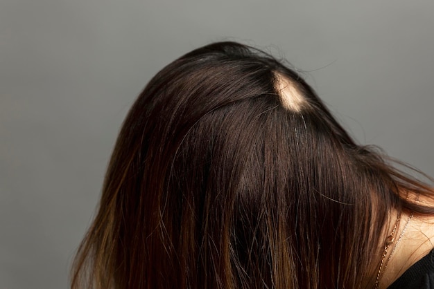 Alopecia op het hoofd van de vrouw. Het gebied zonder haar in een brunette. Stress en cosmetologie. Grijze achtergrond. Detailopname.