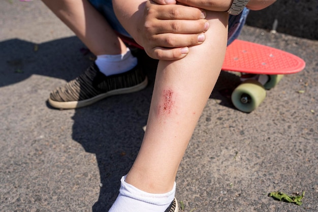 사진 스케이트보드를 타는 동안 아스팔트 경로에 떨어졌을 때 아이의 다리에 부러진 상처 스케이트보드 타는 동안 떨어졌던 소년 익스트림 스포츠