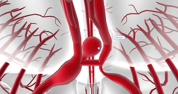 Фото Аневризма – это баллонное расширение кровеносного сосуда из-за ослабления структуры или повреждения стенки сосуда.