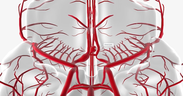 Фото Аневризма – это баллонное расширение кровеносного сосуда из-за ослабления структуры или повреждения стенки сосуда.