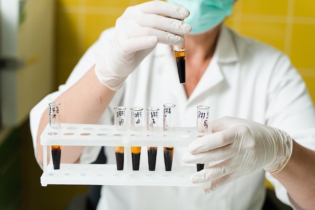 Analysis of blood plasma The laboratory assistant holds a test tube with blood from a vein in his hands and looks at it Blood test in the laboratory Medical scientist with glasses and mask