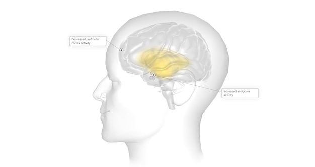 Anxiety is a neurological condition characterized by persistent uncontrollable worry accompanied by emotional distress